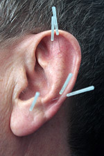 Auricular Acupuncture